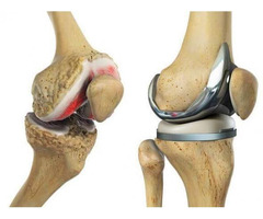 Fast Track Knee Replacement Surgery – Dr Madan Mohan Reddy