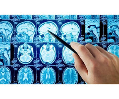 Neurology Hospital in Hyderabad | Neurological Treatment