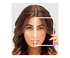 Skin Pigmentation and Dark Spots Treatment in Delhi