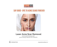 Best Hair Transplant Treatment in India