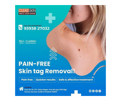 Best Advance Skin Tag Removal In India || Laser Treatment