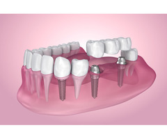 Artificial Teeth Price