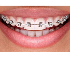 Teeth Braces