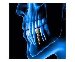 Dentist in AECS Layout-Dental Implants in Aecs Layout