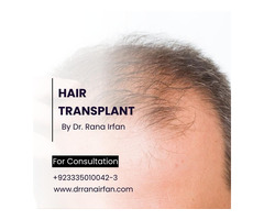 Best Hair Transplant Services in Islamabad Pakistan