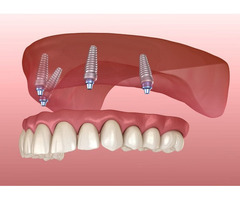 Dental Implant Treatment | Dental Implant Surgeon