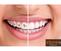 Get the Smile of Your Dreams with Quality and Affordable Teeth Aligners - 2