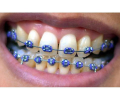 Make your smile dazzle with right teeth braces