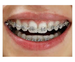 Make your smile dazzle with right teeth braces - 2