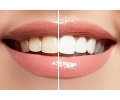 Best Teeth Scaling Cost - 2