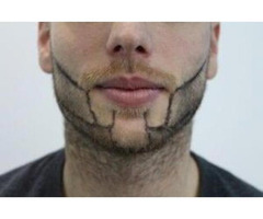 Beard Hair Transplantation