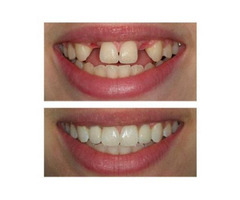 Dental Implants in Plainfield IL: Smile Freely