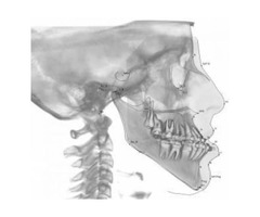 Lateral Ceph Orthodontics