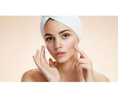 Acne Scar Treatment in Staten Island