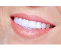 Teeth whitening 50% off