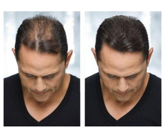 FUE Hair Transplant Surgery in Beverly Hills