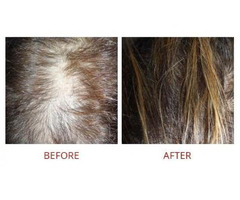 Follicular Unit Extraction/Follicular Hair Transplant, Ca