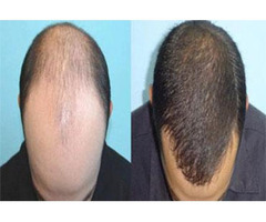 Wigs in Delhi, Hair Wig Manufacturer/ Suppliers in Delhi