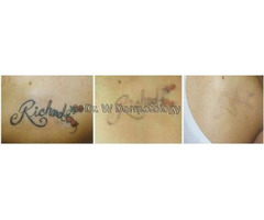 Good Laser Tattoo Removal in Houston