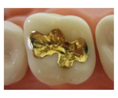 San Diego Porcelain Fillings Treatment