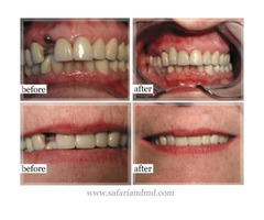 San Diego Dental Implants Treatment