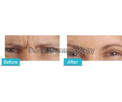 Good Botox in Houston