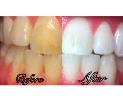 Teeth Whitening in Chicago