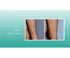 Varicose Vein Removal San Diego