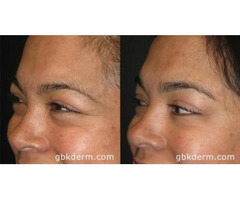 Before And After Botox San Diego
