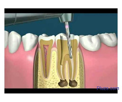 Best Root Canal Specialist Pennsylvania - Media Brite Smile