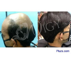 Non surgical hair replacement