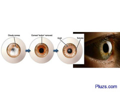 Best Ophthalmologist in Bangalore