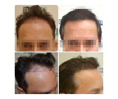 Hair Transplant in Delhi