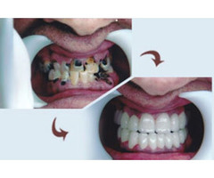Dental Clinic Near Ameerpet | Dental Hospital In Hyderabad - 2