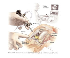 How the right Arthroscopy Doctor can Help