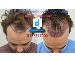 Hair Growth Treatment in Himayat Nagar, Hyderabad