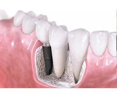 Best Dental Implants In Hyderabad - 2