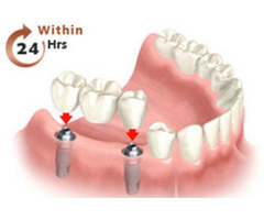 Best Dental Implants In Hyderabad - 3