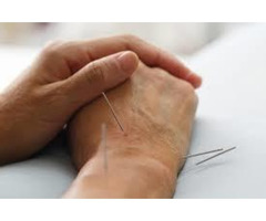 Do You Want Chinese Cupping Therapy In Perth?? - 2