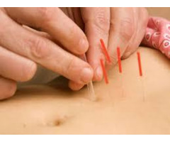 Do You Want Chinese Cupping Therapy In Perth?? - 3