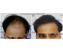 Is Hair Transplantation a Better Choice?