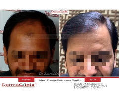 Hair Transplant in Delhi