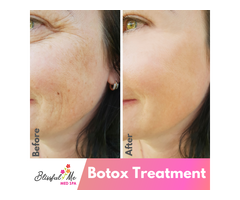 Kybella Injections| The Best, Safest And Effective Treatment