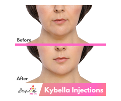 Kybella Injections| The Best, Safest And Effective Treatment - 2