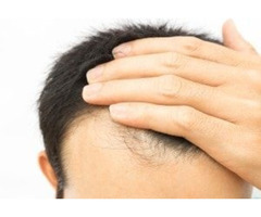 Best Hair Fall Treatment in Delhi