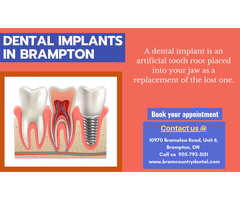 Dental Implants Treatment in Brampton, ON